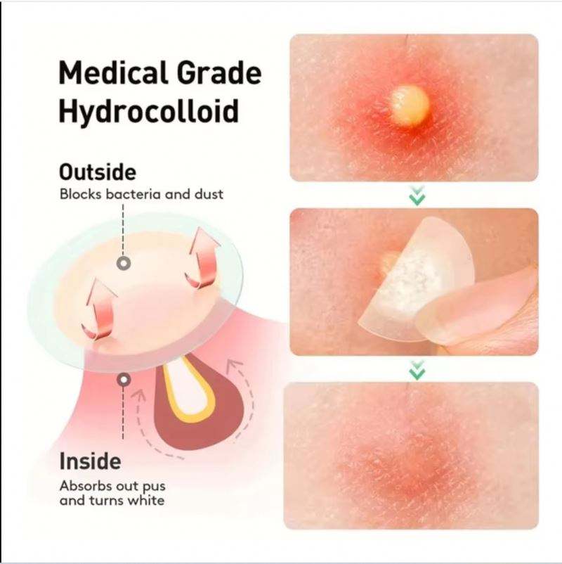 Hydrocolloid Acne Patches – Invisible Pimple Patch for Fast Healing & Scar Prevention.