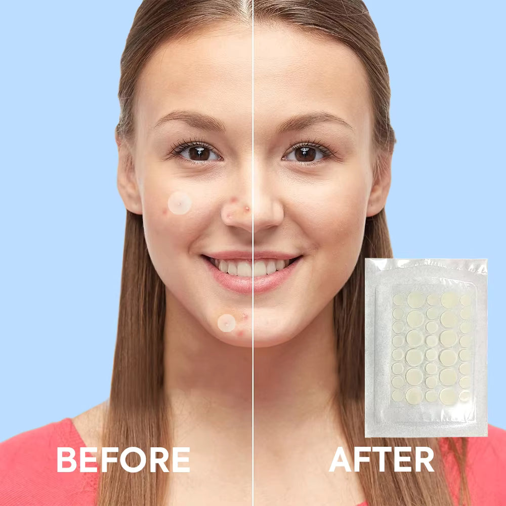 Hydrocolloid Acne Patches – Invisible Pimple Patch for Fast Healing & Scar Prevention.