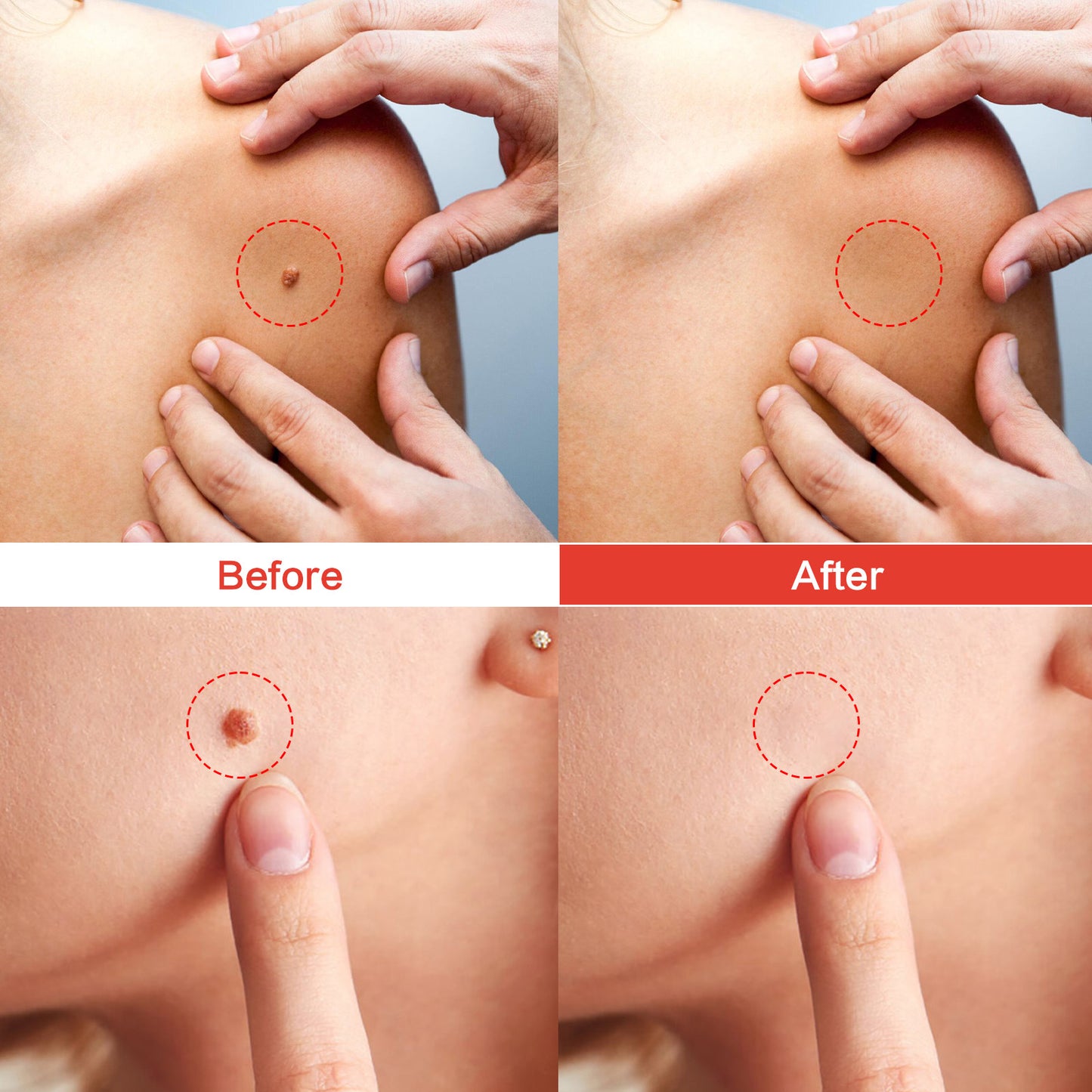 Microdarts Tag Gone Patch – Remove Skin Tags, Warts, Moles & Oil Clogs.