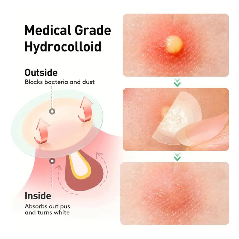 ShobKisu Bd - Hydrocolloid Medical Grade Tape Acne Patch, Blister Bandage & Scars Care.