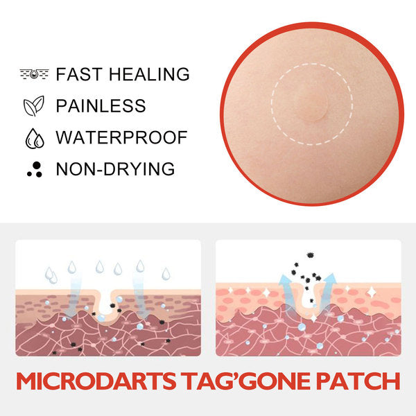 Microdarts Tag Gone Patch – Remove Skin Tags, Warts, Moles & Oil Clogs.