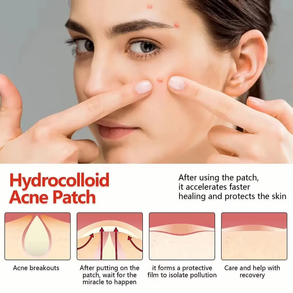 Hydrocolloid Acne Patches – Invisible Pimple Patch for Fast Healing & Scar Prevention.