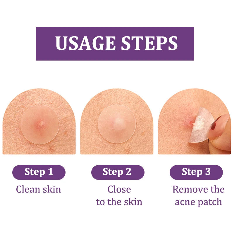 Hydrocolloid Acne Patches – Invisible Pimple Patch for Fast Healing & Scar Prevention.