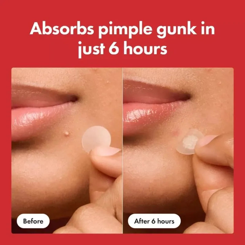 Microdarts Tag Gone Patch – Remove Skin Tags, Warts, Moles & Oil Clogs.