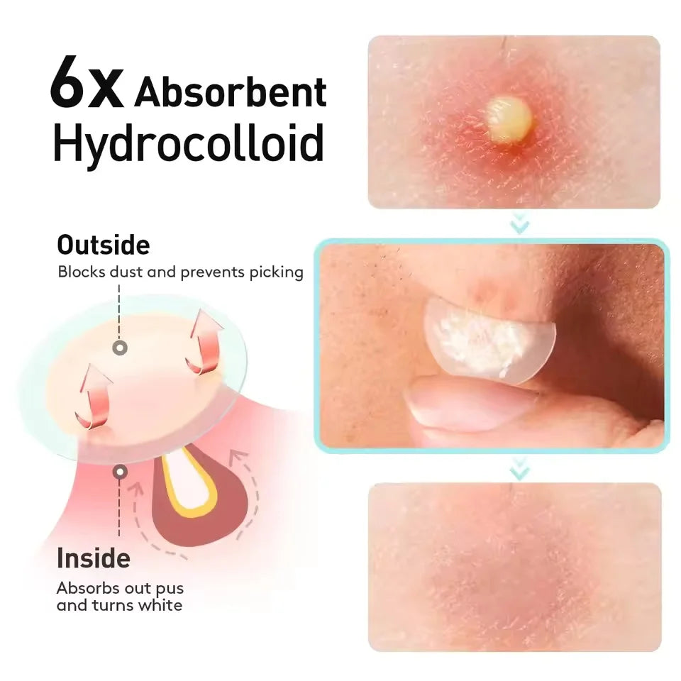 Microdarts Tag Gone Patch – Remove Skin Tags, Warts, Moles & Oil Clogs.
