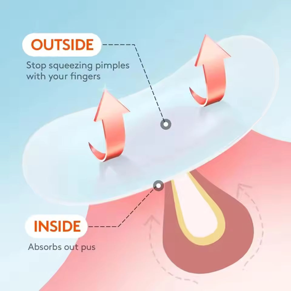 Hydrocolloid Acne Patches – Invisible Pimple Patch for Fast Healing & Scar Prevention.